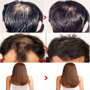 hair loss serum